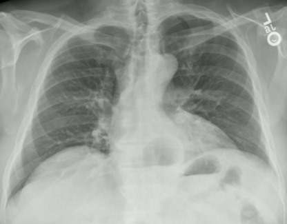 Radiografia evidenciando hérnia de hiato